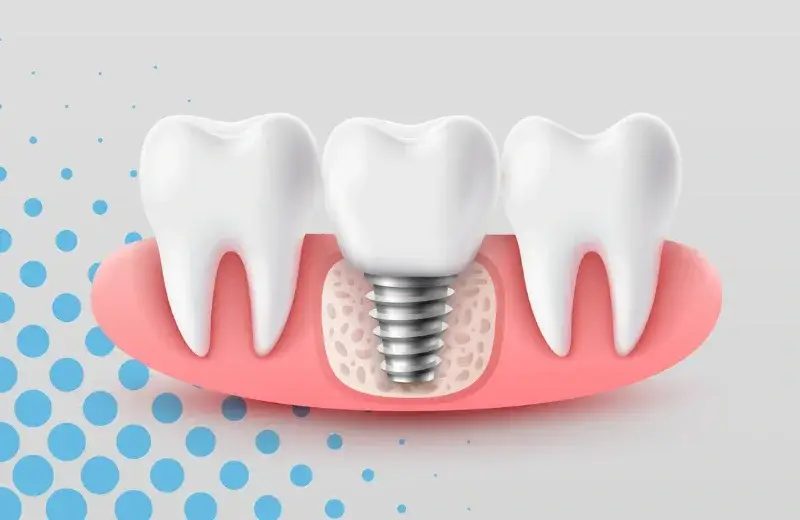 Dentals Implants without surgery