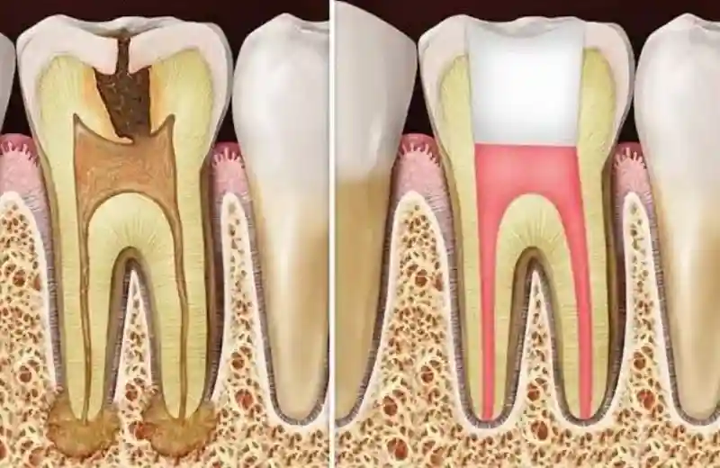 Painless Root Canal Treatment